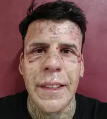 The process leaves significant scarring, but the tattoos are faded. Credit: Leandro de Souza